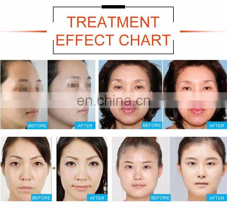 Multifunctional facial care whitening skin tightening wrinkle removal beauty machine