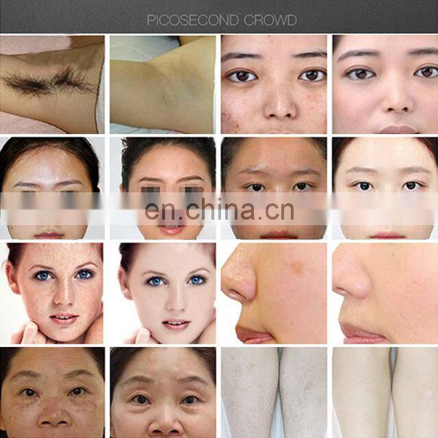 ipl dpl opt hair removal machine opt/ipl/ shr/e-light m22 hair removal machine skin rejuvenation