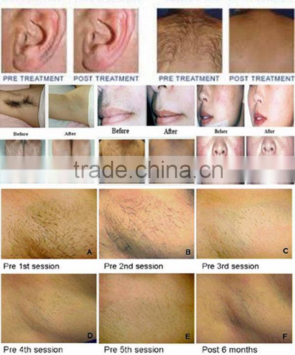 Raynol 1-10Hz diode laser hair removal/lightsheer diode laser