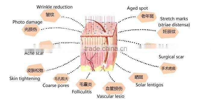 30W RF Mental Tube CO2 Laser Fractional Acne Scar Removal Machine