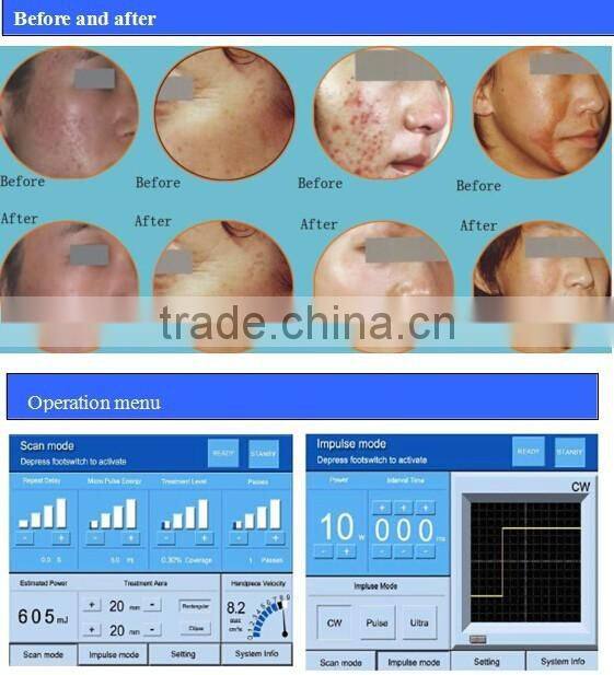 New rf co2 fractional laser for sale /fractional co2 laser/co2 fractional laser