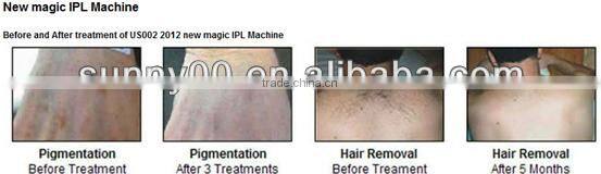 IPL permanent hair reduction