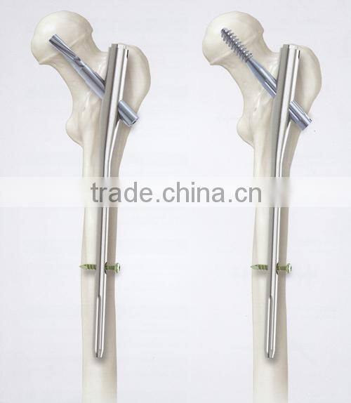 GT-420 High Quality bone nail for femoral