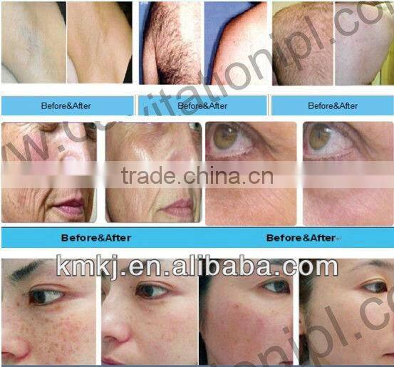 New advanced lumea ipl hair removal system with a big discount!!!