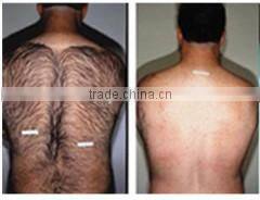 Hot sale SHR beauty equipment improve facial micro-circulation, IPL SHR hair removal beauty machine for sale - A011