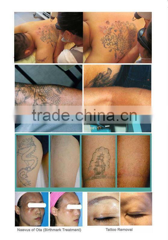 1064nm 532nm q switch nd yag laser tattoo removal