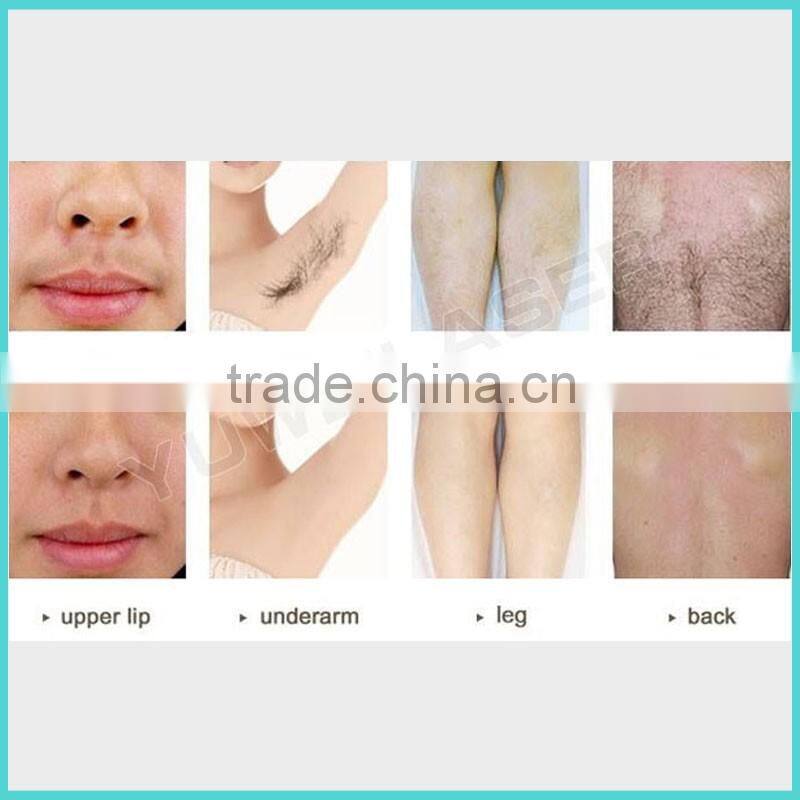 hair removal YUWEI High tech painless ease of use