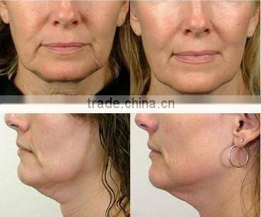 NL-RU501 BEST! portable radio frequency facial machine/ high quality bipolar rf machine(CE)