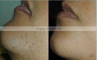 Renew The Elasticity Of Skin Photofacial IPL Equipment---A005