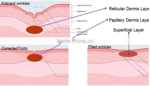 skin renewal micro needle fractional rf laser acne removal machine