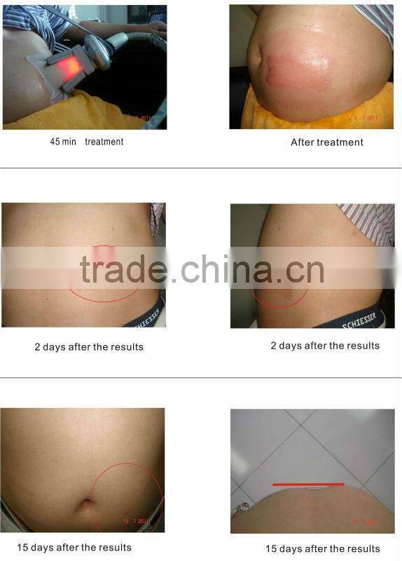 Lingmei TSL Liposuction criolipolise 3 handles cryolipolysis fat freeze home use criolipolise machine