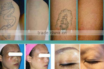 Long pulsed ND YAG laser for tattoo removal