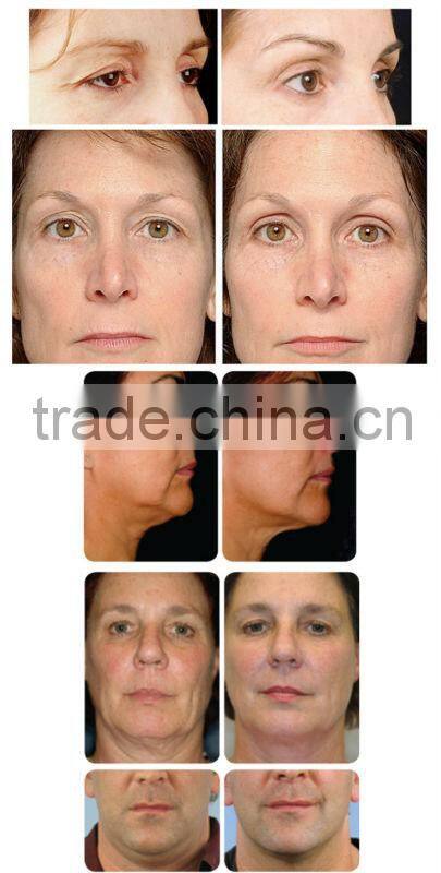 mini radio frequency facial device CE