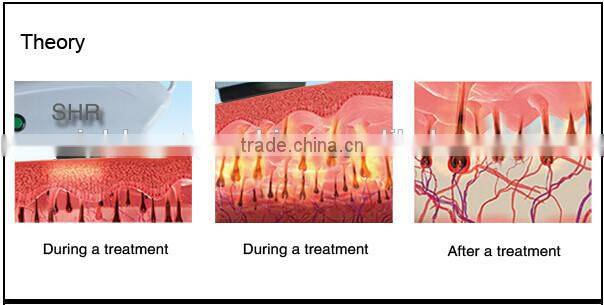 2016 newest design long puse hair removal laser