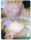 epilator pulsed light ipl skin rejuvenation machine A003