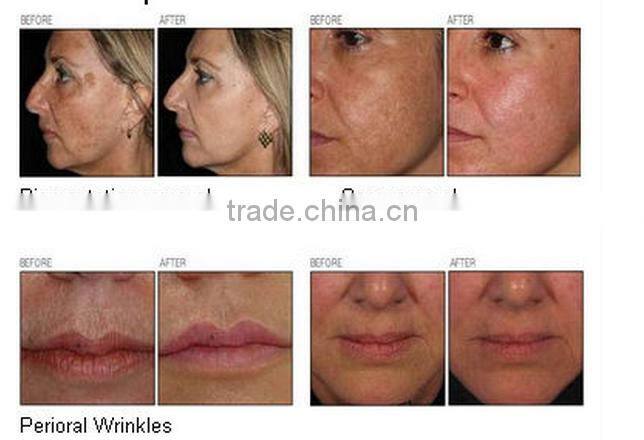 Co2 fractional laser vaginal tightening equipment