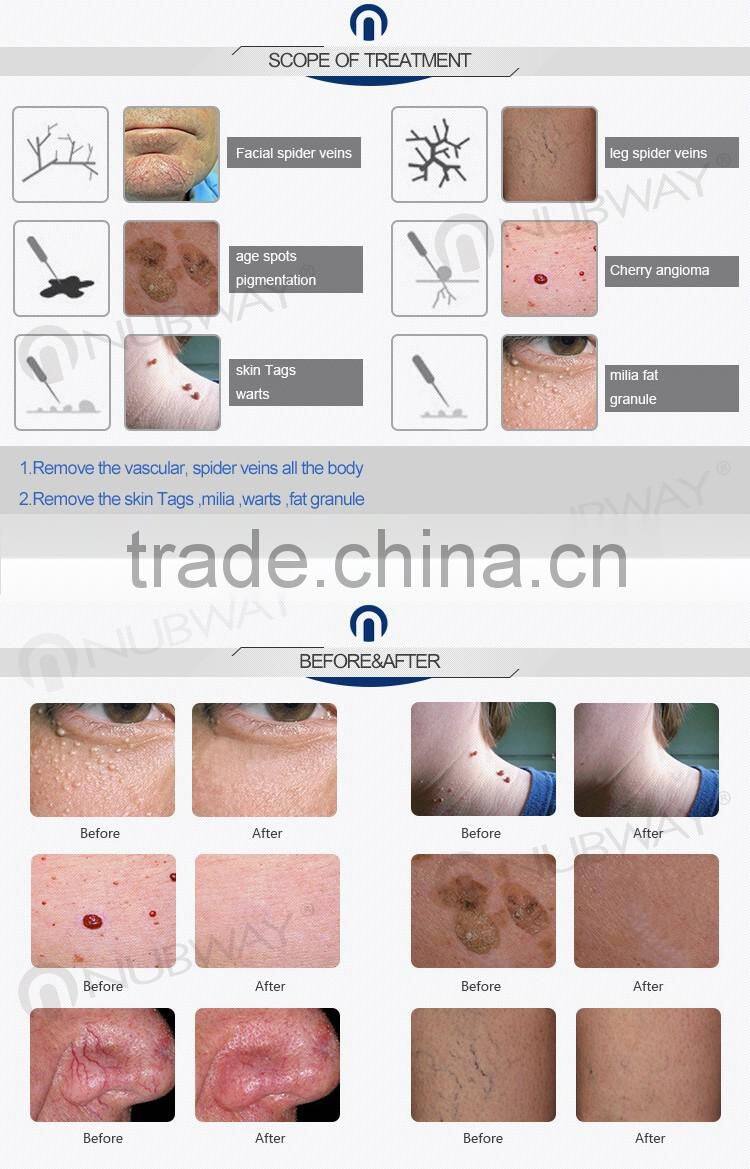 Professional RBS vein wave machine facial and leg rf spider vein removal machine