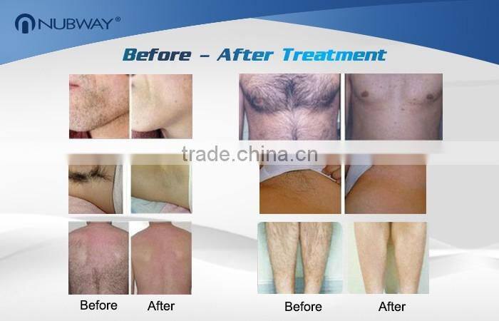 Top Sale Professional Salon Machine threading 808nm Diode Laser Hair Removal