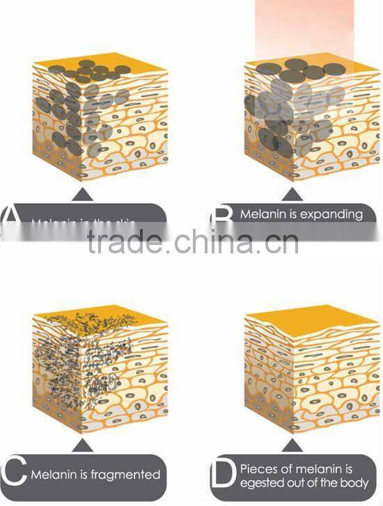 Nd:yag Q-switch pigment arm tattoo removal laser