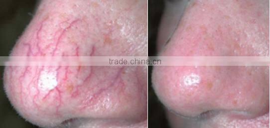 Promotion Effective Vascular Removal Machine Diode Laser 980