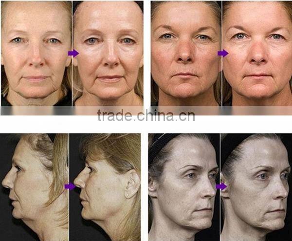 Big Spot Size 16mm*50mm HR+SR+VR IPL Machine for Wrinkle Removal