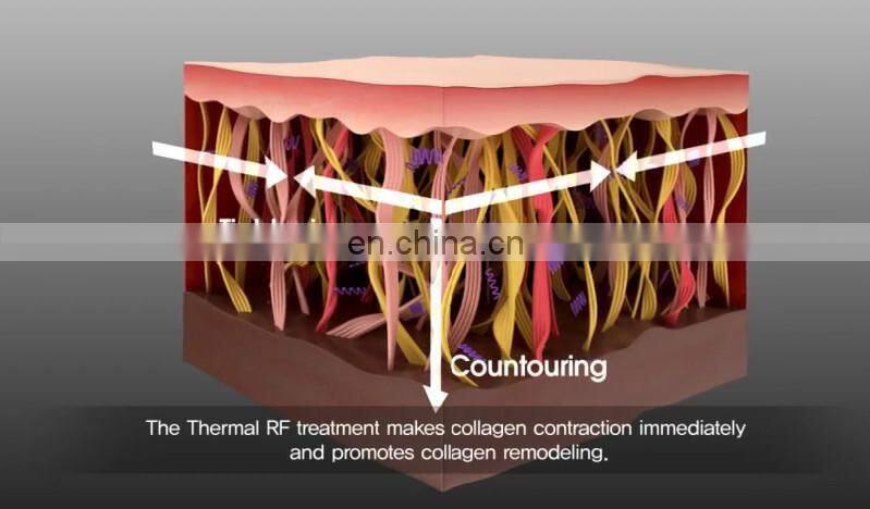 2015 Matrix Fractional Microneedle RF& microneedle Fractional RF for face lifting with CE, ISO