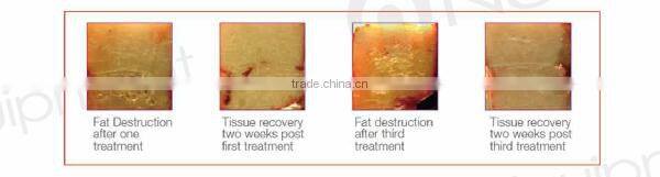 New products 2016 weight loss machine hifushape hifu slimming machine