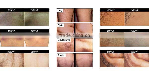 Newest 2000W 20 Million Shots Warranty! 808nm Diode Laser Hair Removal Machine/Supply OEM&ODM Spare Parts/Hand Piece