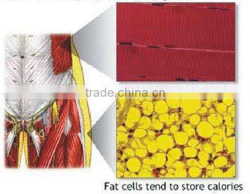 HIFU vrf rf cellulite loss treatment