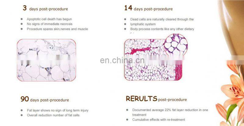 2021 Big discount High quality multifunctional 360 degree 4 headles work together cryolipolysis machine with RF cavitation