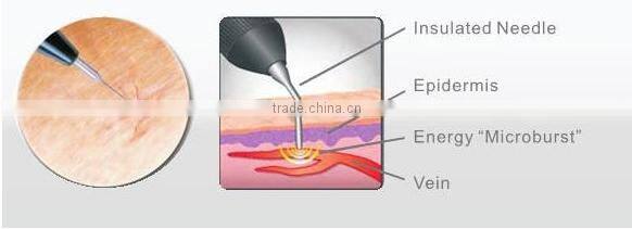 New Year Trending Hot Products Laser Veins Removal Machine For Sale/ Vascular Spider Vein Removal Machine