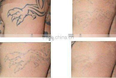 666 Good quality portable tattoo removal Q switch nd yag laser equipment for pigment removal and skin toning