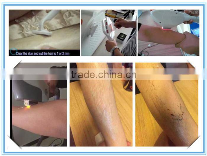 shr ipl / elight shr / shr ipl hair removal