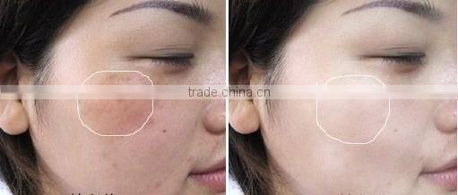 Hot selling new design professional beauty equipment shr ipl cricket score live today photofacial machine