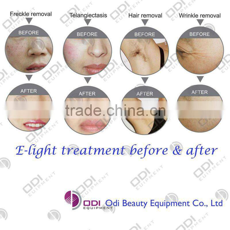 portable IPL+RF+Laser 3in1 home use beauty multi-functional machine(CE)(IRL20)