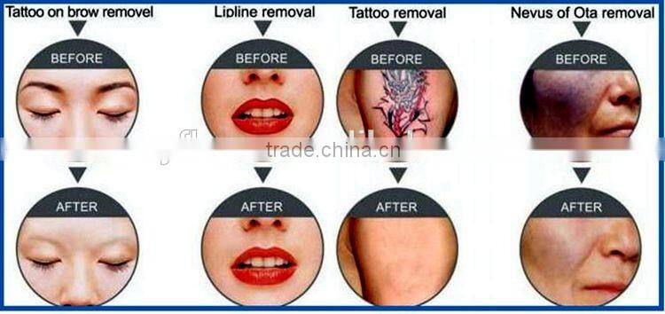 Manufacture skin rejuvenation lip line removal tatto laser machine