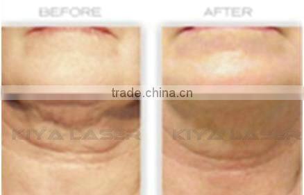 ultrasound cavitation slimming gel for cavitation