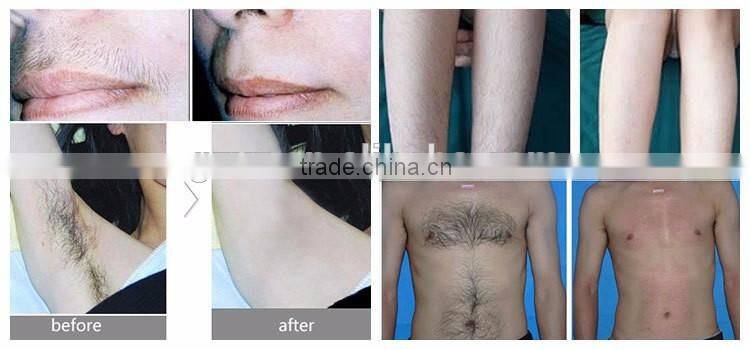 2016 CE Approved Non invasive 808nm diode laser hair removal price /permanent hair removal machine for sale