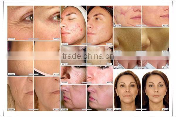 2016 derma rolling system micro needles skin care roller with 1200 needles