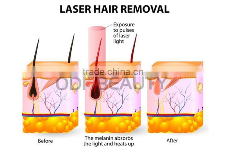 Permanent laser hair removal facial hair removal for women