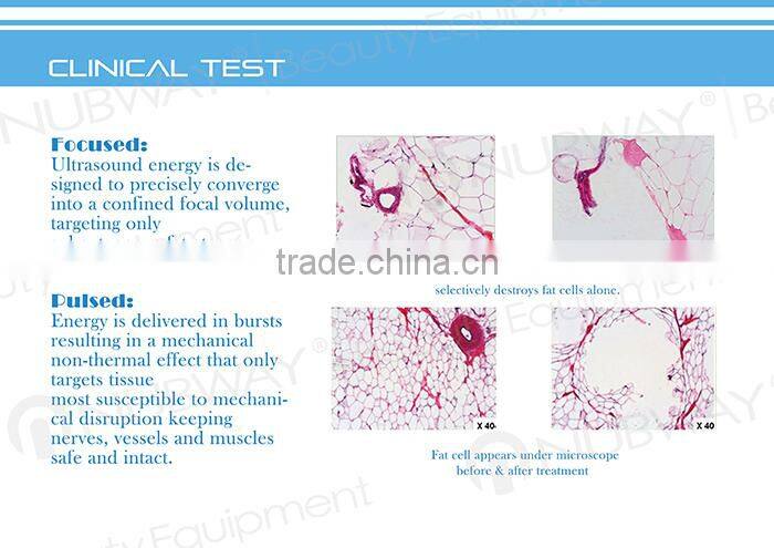 Nubway technology!!! korean hifu 2015 for body shape machine