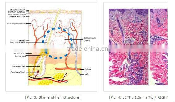 2 professional treatment handles radiofrecuencia fraccionada
