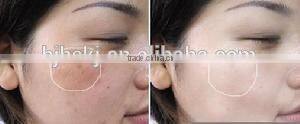 new professional Rhytidectomy skin resurfacing fractional co2 laser ablation