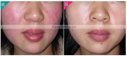 RBS03 CE approved 980nm diode laser for spider veins removal blood vessels removal machine