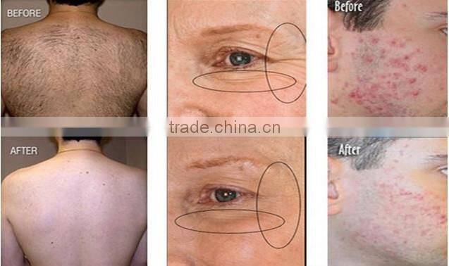 Hot selling multifunctional hair removal, skin care, wrinkle removal device ipl shr ssr