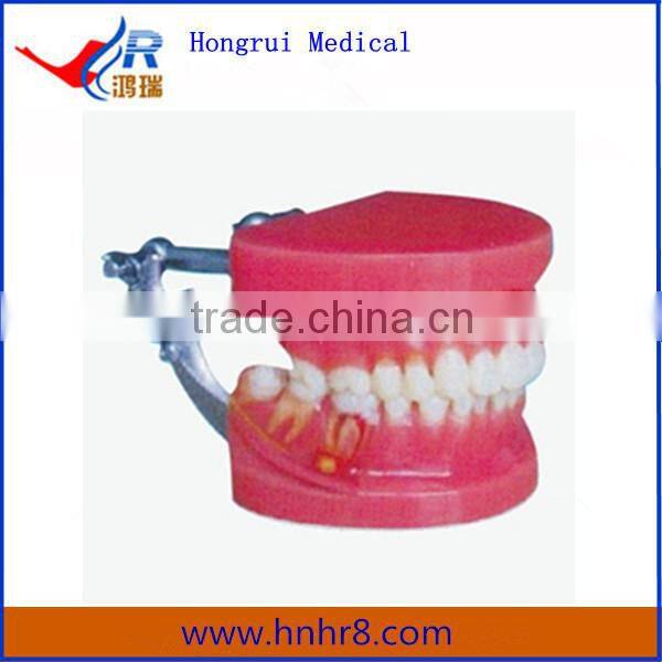 Dental Teeth Periodontal Disease Demonstration Teaching Model