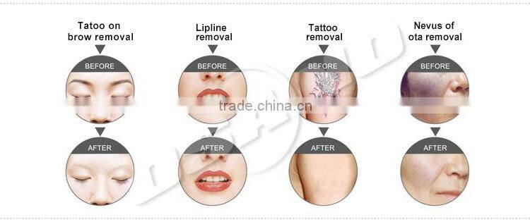 Top Quality Clinic Beauty Machine 532nm 1064nm Black Doll Treatment