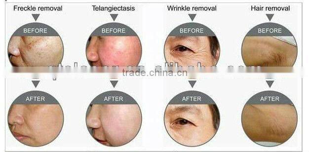 products 2015 alexandrite laser hair rmeoval machine looking for sole agent distributor