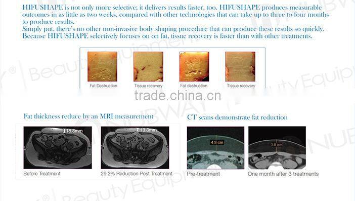 ultrasonic weight loss treatment ultrashape fda