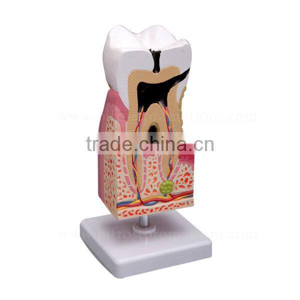 Handmade Pathology Plastic Teeth Tooth Model